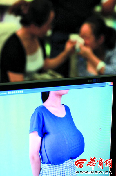 宝鸡12岁少女胸围105公分 巨乳如篮球重达10